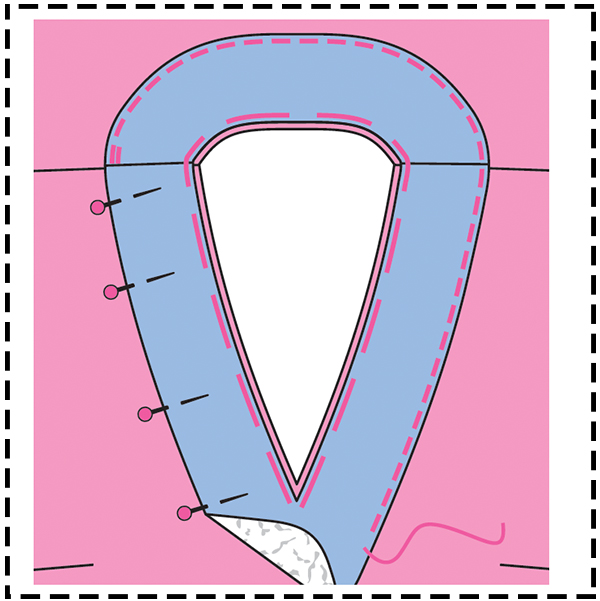 STEP 13: CONSTRUCT LINING STEP 13: CONSTRUCT LINING